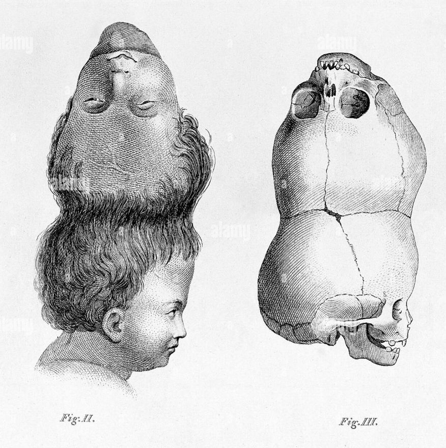 duas cabeças, craniopagus parasiticus